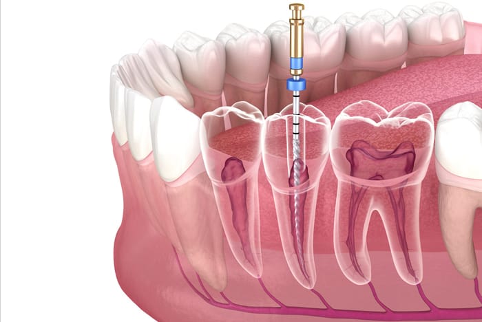 Endodontia – tratamento de canal